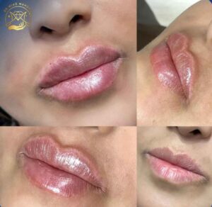 تزریق ژل لب در اسلامشهر