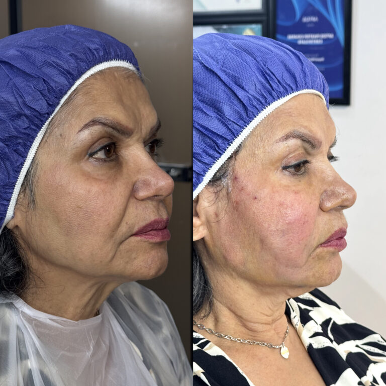 عکس قبل و بعد لیفت صورت با نخ |دکتر میعاد مهدوی