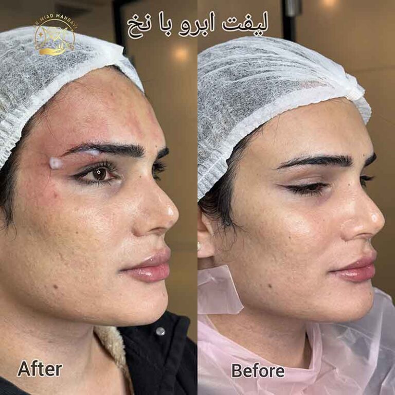 لیفت صورت با نخ