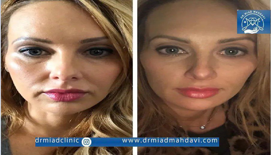 لیفت پیشانی با نخ:مزایا ،عوارض،مراقبت قبل و بعد 2 لیفت با نخ پیشانی