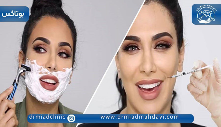 همه چیز درباره اصلاح صورت بعد از بوتاکس 4 اصلاح صورت بعد از بوتاکس با تیغ و ژیلت.