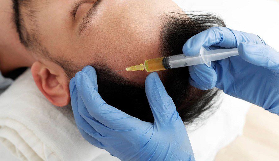 تزریق پی آر پی مو prp