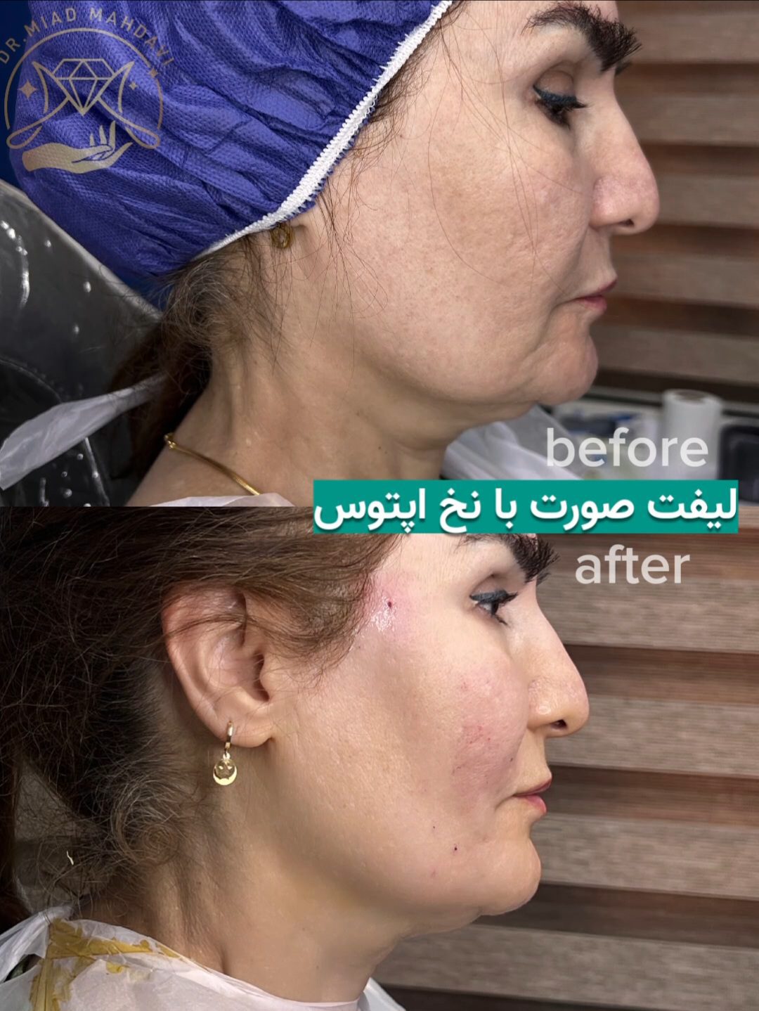 لیفت با نخ اپتوس | دکتر میعاد مهدوی