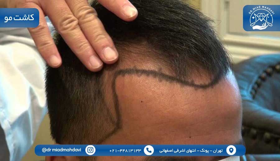 پزشک پوست مو غرب تهران | هرآنچه باید بدانید 2 پزشک پوست مو غرب تهران|کلینیک پوست مو و زیبایی دکتر میعاد مهدوی|کاشت مو
