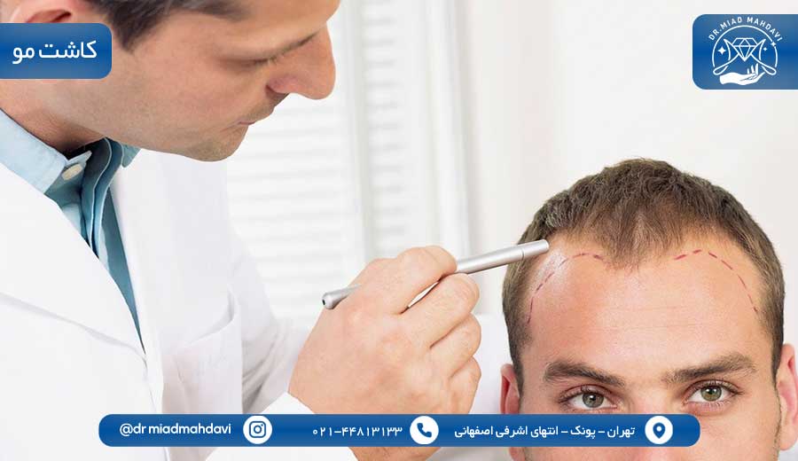 پزشک پوست مو غرب تهران | هرآنچه باید بدانید 1 بهترین پزشک پوست مو غرب تهران|کاشت مو|دکتر میعاد مهدوی
