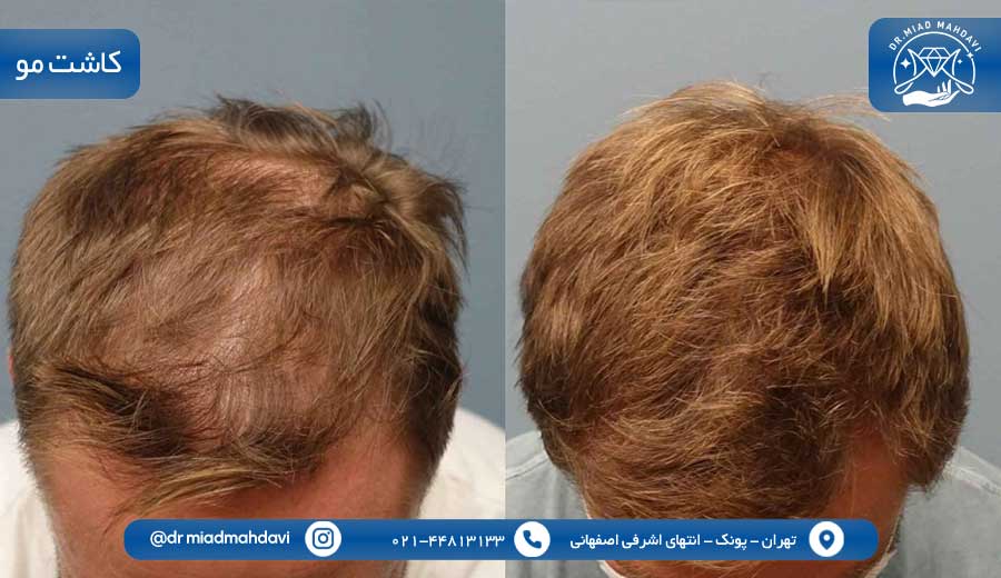 پزشک پوست مو غرب تهران | هرآنچه باید بدانید 3 کاشت مو |درمان ریزش مو با مزوتراپی و پی آر پی |کلینیک پوست مو و زیبایی دکتر میعاد مهدوی