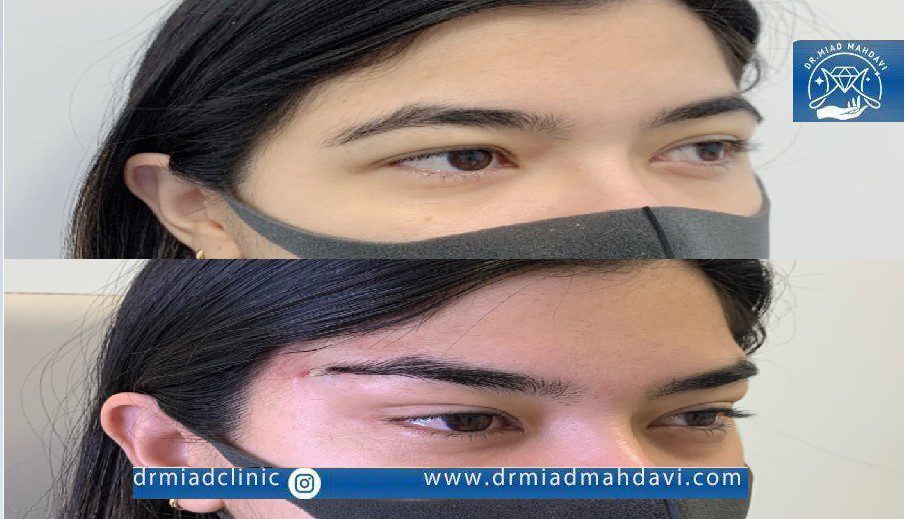 عکس لیفت ابرو با نخ