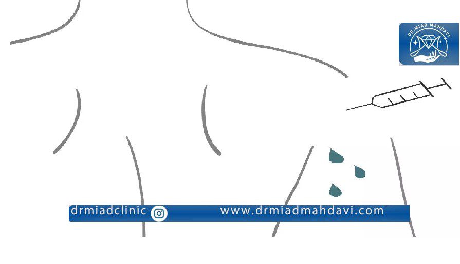 تزریق بوتاکس زیر بغل | دکتر میعاد مهدوی