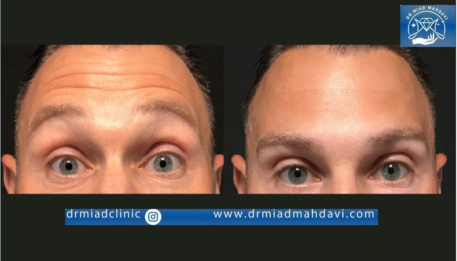نتیجه بوتاکس برای پیشانی