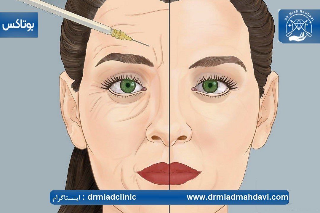 بوتاکس خط اخم و 7 مزیت آن 5 مقایسه دو نیمه صورت نیمه صاف صورت و نیمه چروک صورت و درمان خطوط روی صورت با بوتاکس