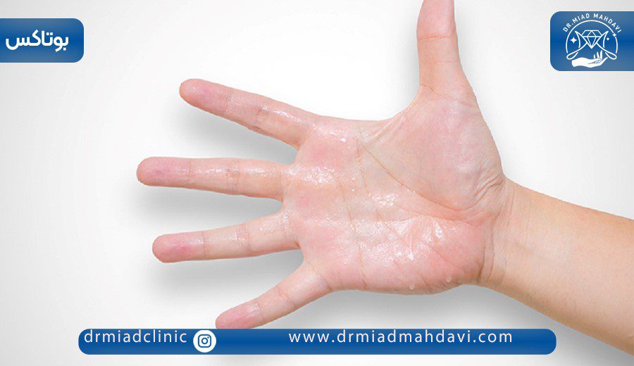 همه چیز درباره بوتاکس کف دست برای تعریق 1 بوتاکس کف دست