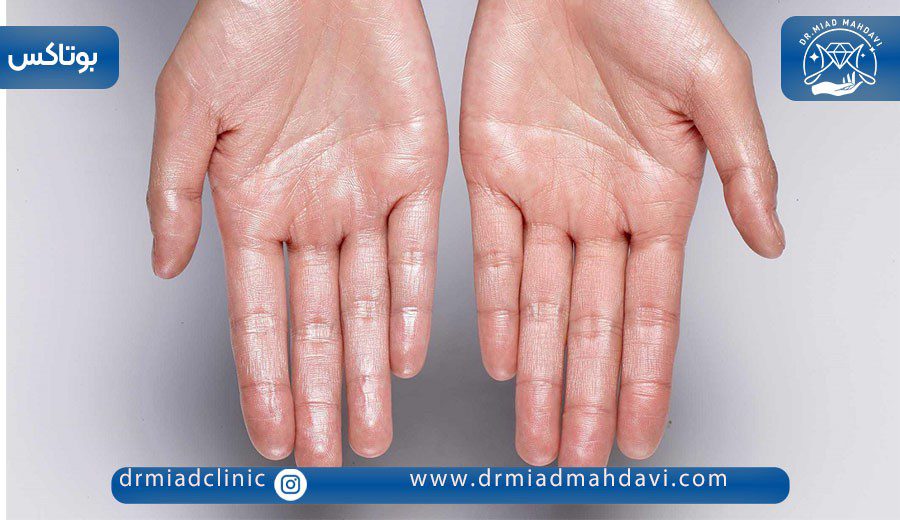 همه چیز درباره بوتاکس کف دست برای تعریق 2 هیپرهیدروز کف دست