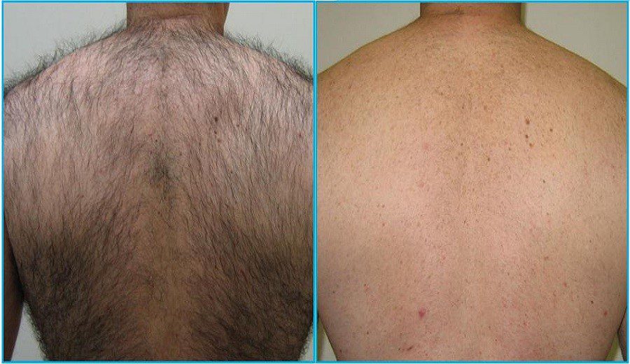 مقایسه بدن لیزر شده|لیزر موهای زائد، موهای زائد