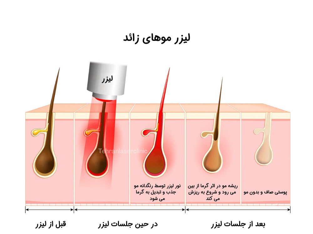 لیزر موهای زائد کل بدن چند جلسه نیاز دارد؟ 2 مدت زمان لازم برای هر جلسه لیزر موهای زائد کل بدن