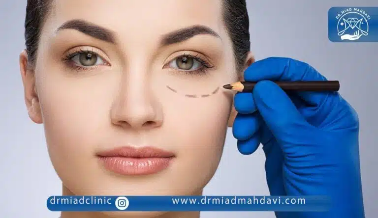 تزریق فیلر زیر چشم