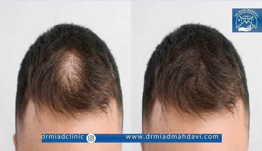 عکس قبل و بعد مزوتراپی مو