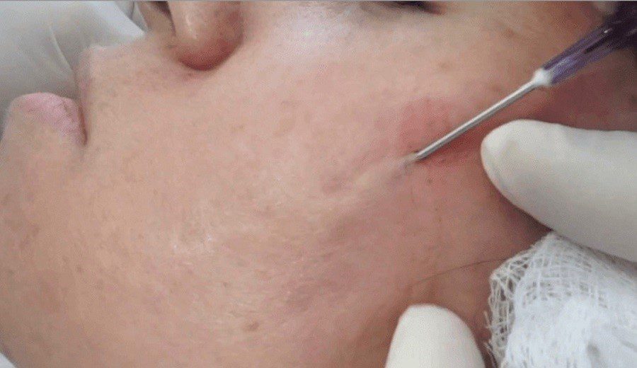 عکس نحوه سابسیژن صورت | دکتر میعاد مهدوی