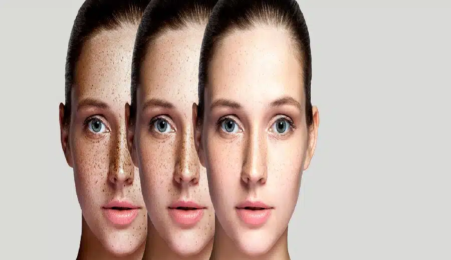 درمان لک صورت با مزوتراپی | دکتر میعاد مهدوی