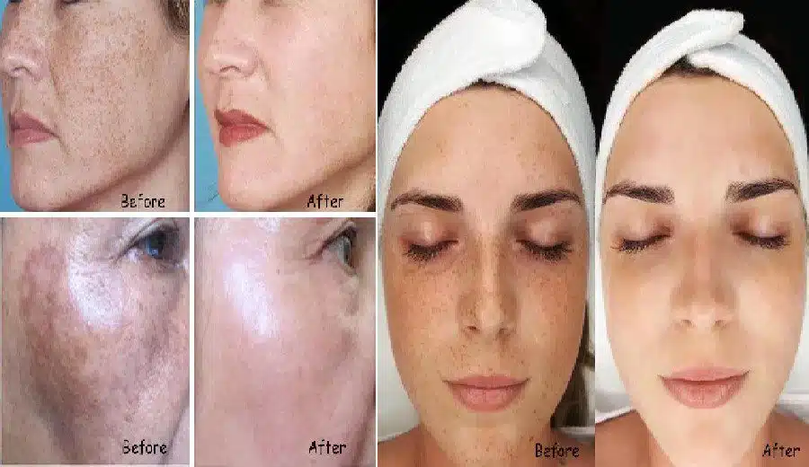 قیمت مزوتراپی و نتایج حاصل از آن| کلینیک زیبایی دکتر میعاد مهدوی