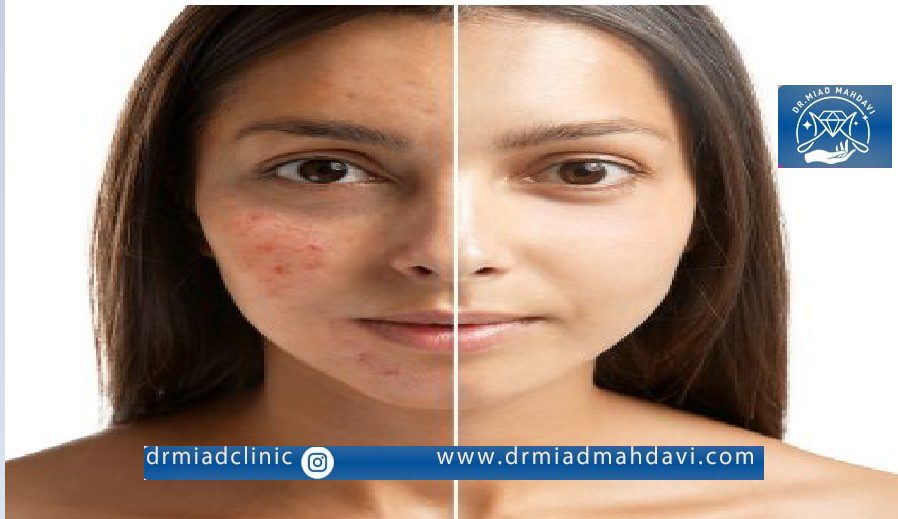 لیزر اندولیفت برای جای جوش موثر است؟ درمان صد در صدی لک ها با لیزر اندولیفت 4 تاثیر فوق العاده اندولیفت روی از بین بردن لک های پوستی