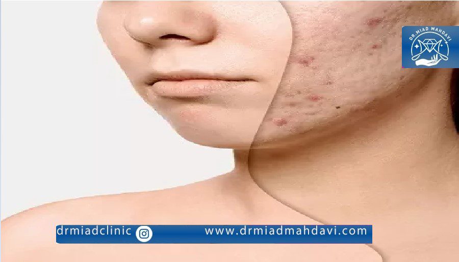 لیزر اندولیفت برای جای جوش موثر است؟ درمان صد در صدی لک ها با لیزر اندولیفت 1 لیزر اندولیفت برای جای جوش| انجام اندولیفت با بهترین متخصص زیبایی در تهران