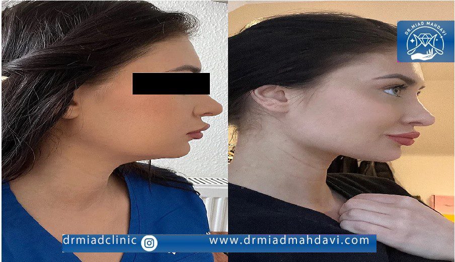 عکس قبل و بعد اندولیفت بینی و نتایج بی نظیر آن