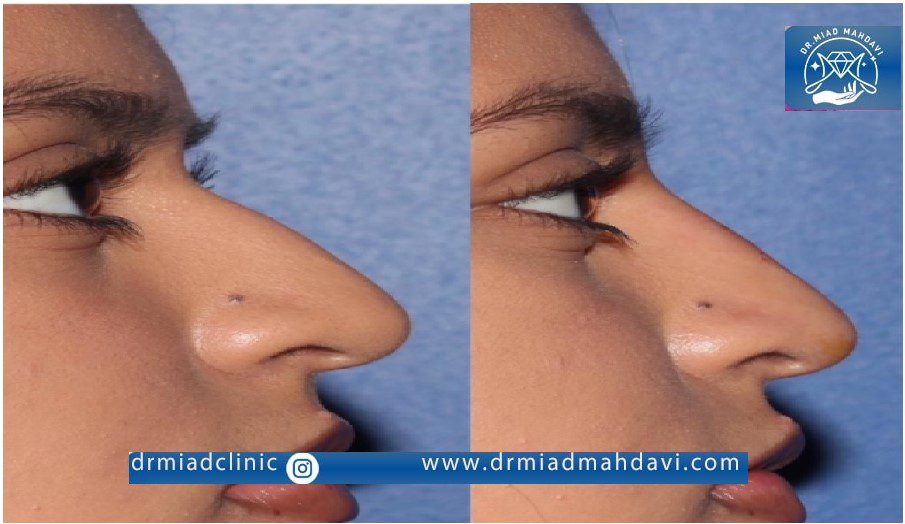 تاثیر فوق العاده اندولیفت روی اصلاح فرم و زیبا سازی بینی