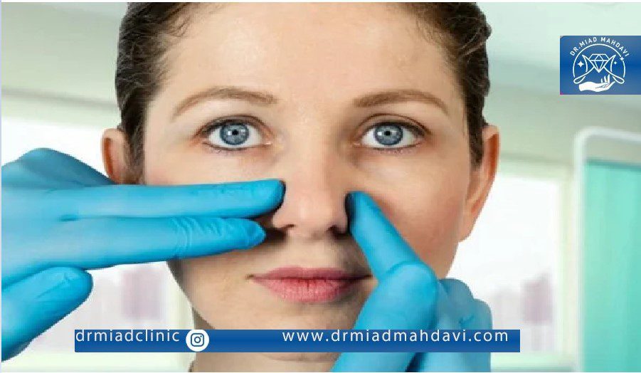 ترمیم بینی گوشتی به وسیله اندولیفت
