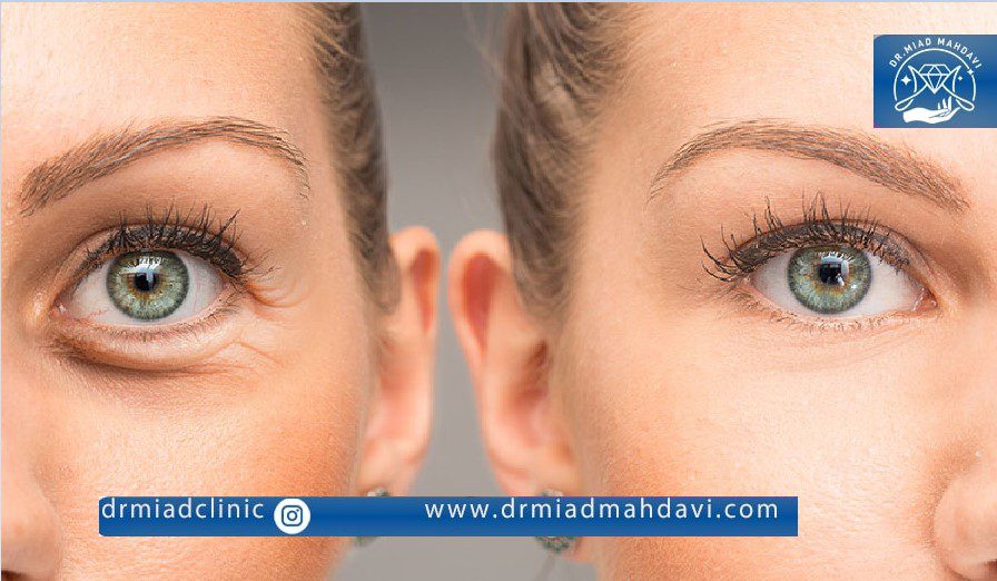 لیفت زیر چشم به وسیله اندولیفت در کلینیک دکتر میعاد مهدوی