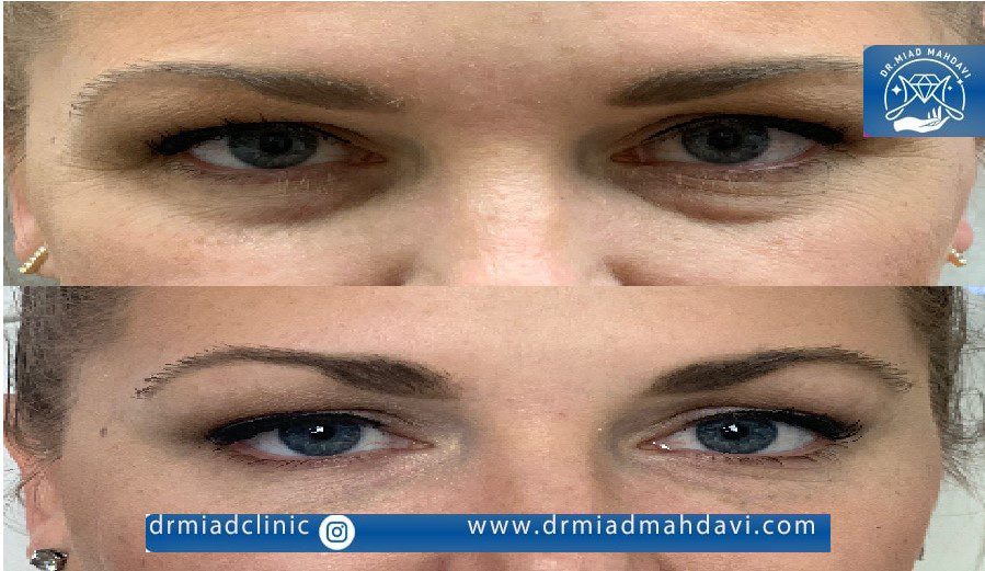 تاثیر فوق العاده اندولیفت زیر چشم در کلینیک دکتر مهدوی