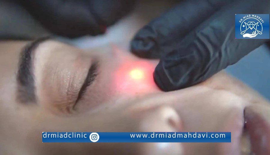 اندولیفت زیر چشم |درمان تیرگی زیر چشم با اندولیفت