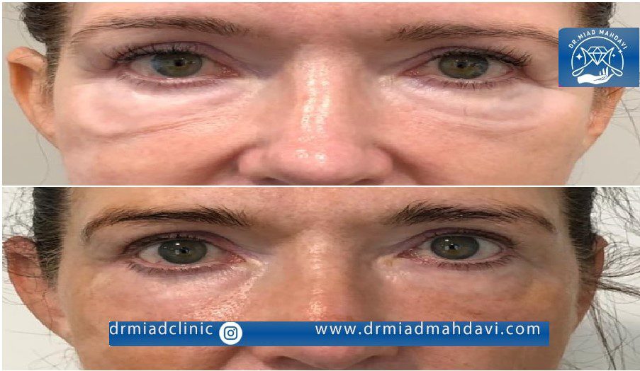 اندولیفت زیر چشم برای رفع تیرگی
