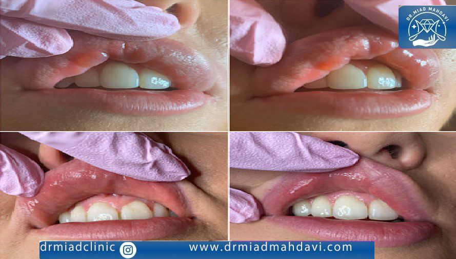 ایجاد کیست پس از تزریق ژل لب و تخلیه آن