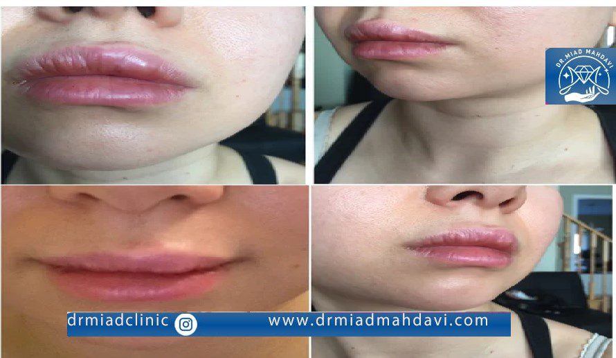 مراجعه به پزشک برای رفع گلوله شدن ژل لب