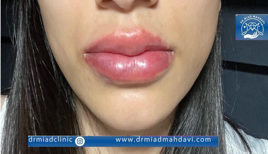 ورم بعد از تزریق ژل لب چند روز طول میکشد؟ 2 ورم لب چند ساعت پس از تزریق ژل