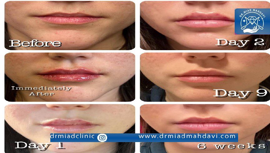 ورم بعد از تزریق ژل لب چند روز طول میکشد؟ 3 روند تغییر ورم لب بعد از تزریق ژل در کلینیک زیبایی دکتر میعاد مهدوی