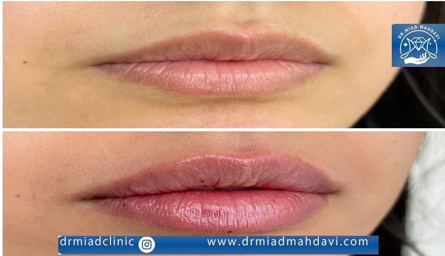 ورم بعد از تزریق ژل لب چند روز طول میکشد؟ 4 کبودی و تورم طبیعی لب بعد از تزریق در کلینیک دکتر میعاد مهدوی