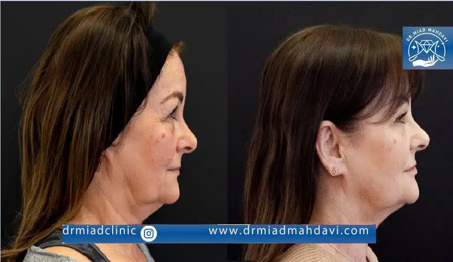اندولیفت غبغب چیست؟ راهنمای رفع غبغب بدون جراحی 1 لیفت غبغب به وسیله اندولیفت در کلینیک دکتر میعاد مهدوی