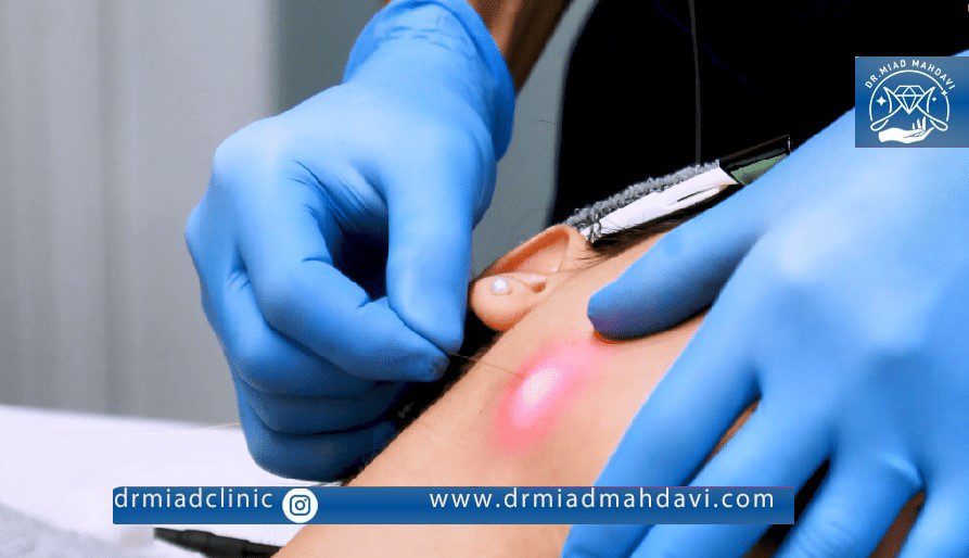 آشنایی با لیزر اندولیفت و مزایای آن