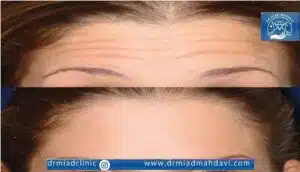 نتیجه لیفت کردن پیشانی به وسیله لیزر اندولیفت در کلینیک دکتر میعاد مهدوی