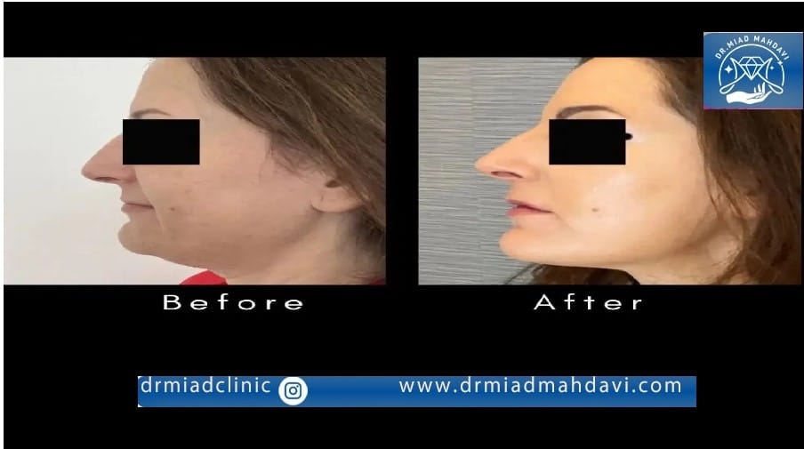 تاثیر فوق العاده اندولیفت صورت برای جوان سازی و از بین بردن لک های پوستی