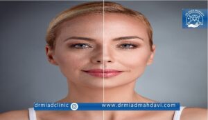 انجام اندولیفت صورت تحت نظر بهترین متخصص زیبایی در تهران