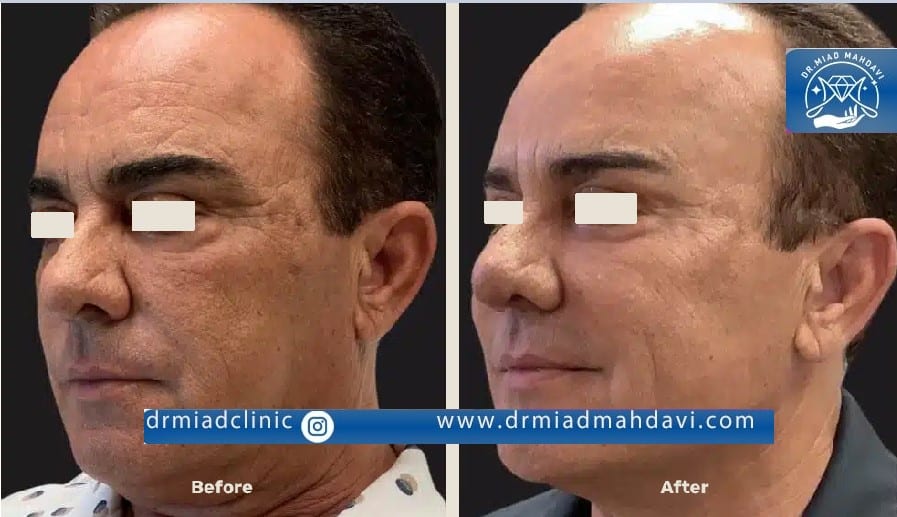 اندولیفت و جوان سازی پوست برای آقایان در کلینیک دکتر مهدوی