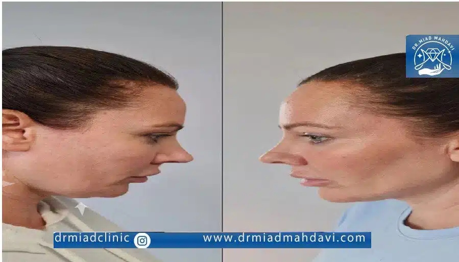 اندولیفت غبغب چیست؟ راهنمای رفع غبغب بدون جراحی 3 اندولیفت غبغب با بهترین متخصص در تهران