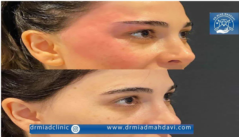 لیفت پیشانی بعد از اندولیفت در کلینیک زیبایی دکتر میعاد مهدوی