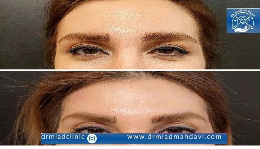 اندولیفت پیشانی چیست؟ بررسی مزایا+ معایب و هزینه 1403 3 تاثیر فوق العاده اندولیفت پیشانی روی لیفت کردن شقیقه و جوان سازی
