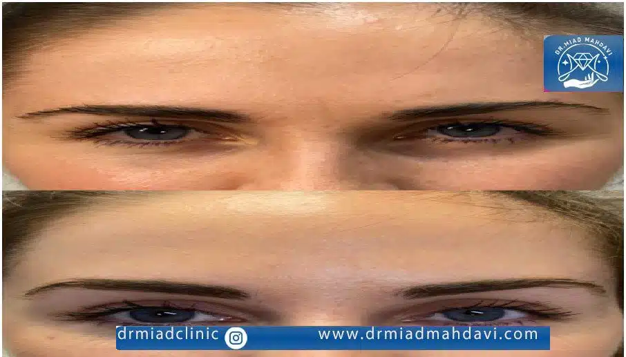 اندولیفت پیشانی چیست؟ بررسی مزایا+ معایب و هزینه 1403 4 انجام اندولیفت پیشانی و لیفت شقیقه با بهترین متخصص در تهران