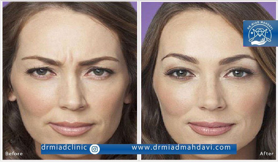 اندولیفت پیشانی در کلینیک زیبایی دکتر میعاد مهدوی برای جوان سازی