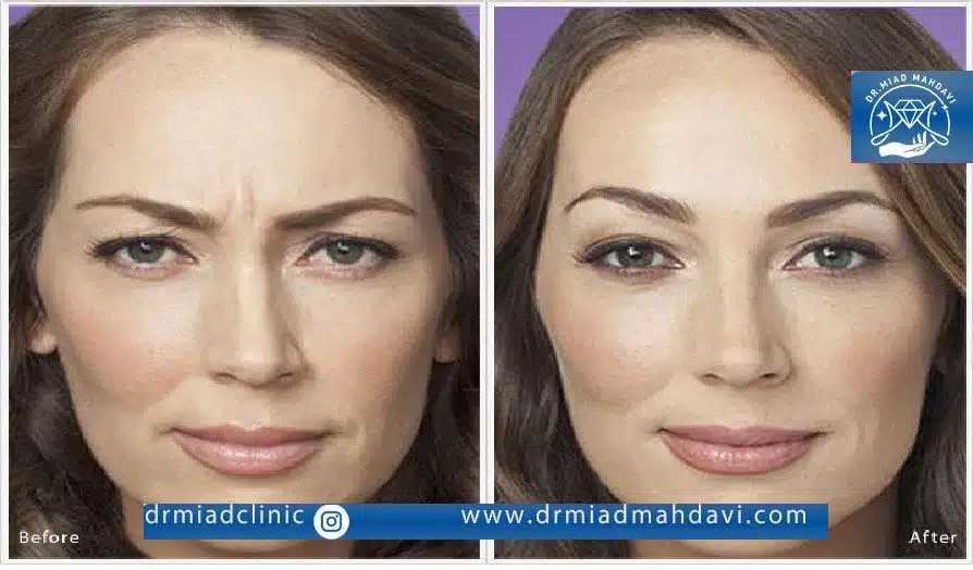 اندولیفت پیشانی چیست؟ بررسی مزایا+ معایب و هزینه 1403 5 اندولیفت پیشانی در کلینیک زیبایی دکتر میعاد مهدوی برای جوان سازی