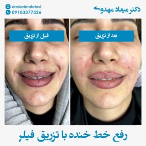 فیلر خط خنده |دکتر میعاد مهدوی